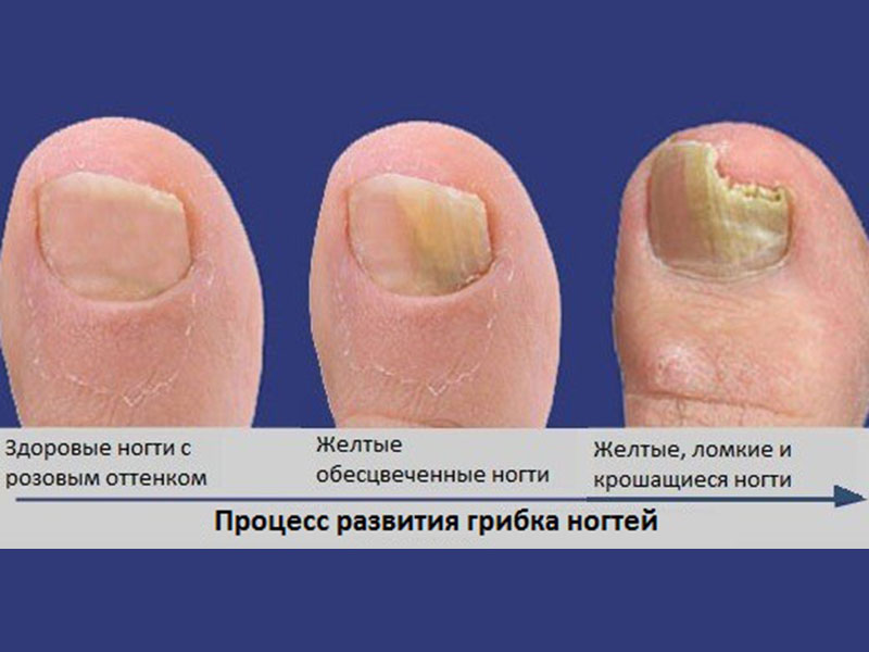 Причины, симптомы и эффективное лечение грибка ногтей