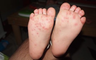 Лечение грибка на ногах у ребенка и причины появления заболевания