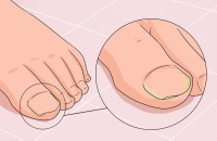 Грибок на ногтях ног: к какому врачу обратиться?