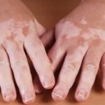 Депигментация кожи рук