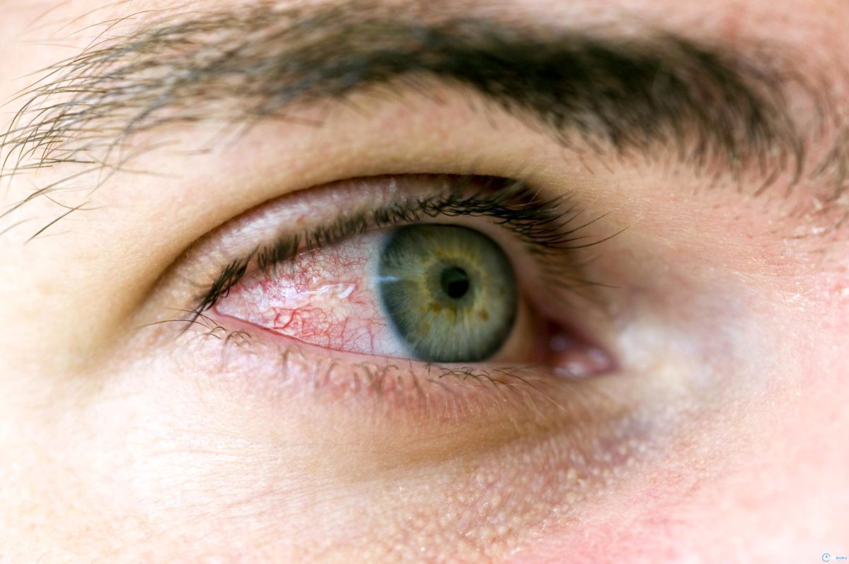 Общая болезненность при моргании и движении глазами